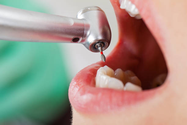 Best Emergency Tooth Extraction in Seis Lagos, TX